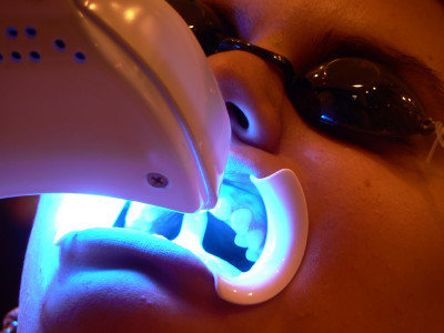 Teeth Whitening in Bangkok: Bangkok Dental Image